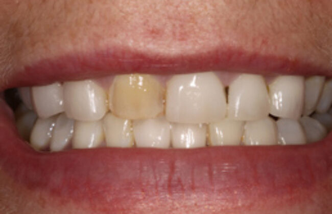 Before (Teeth)