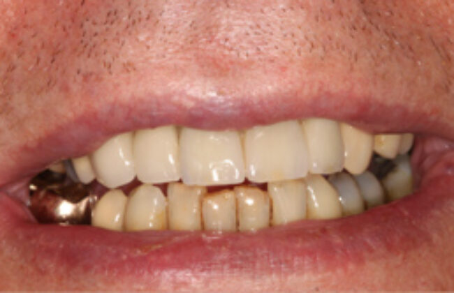 After (Teeth)