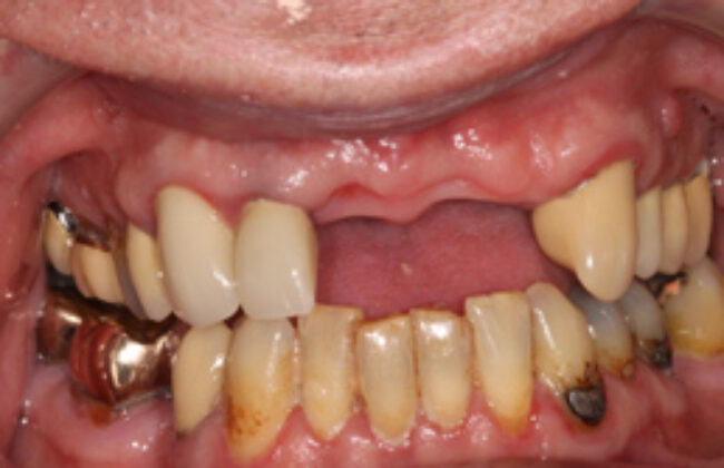 Before (Teeth)