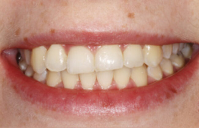 After (Teeth)