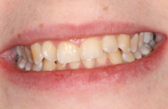 Before (Teeth)