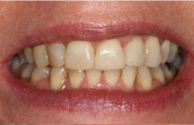 After (Teeth)