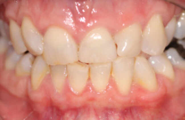 Before (Teeth)