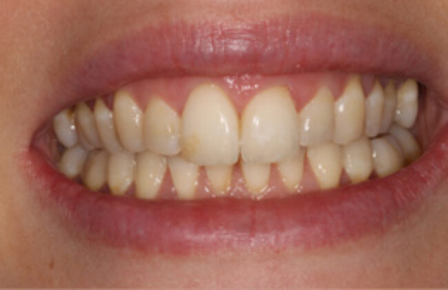 After (Teeth)