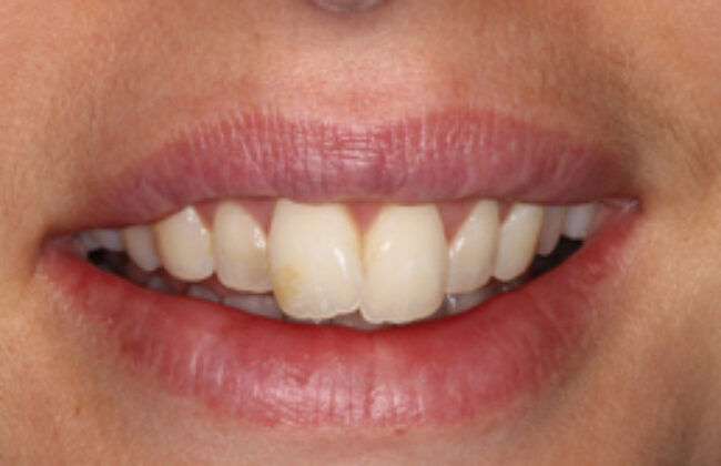 Before (Teeth)