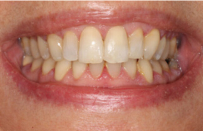 After (Teeth)