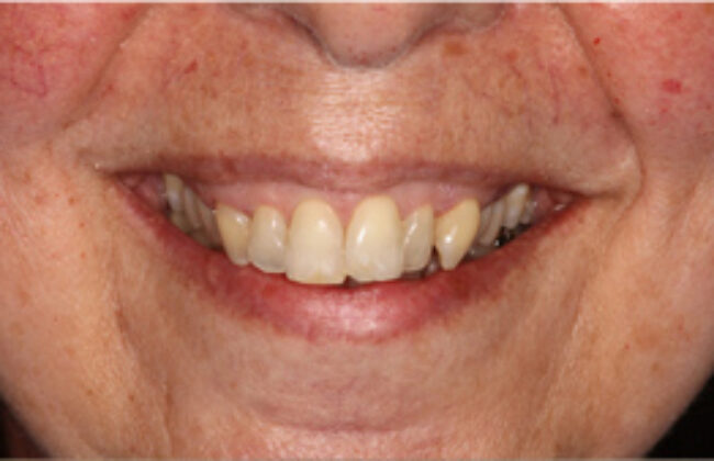 Before (Teeth)