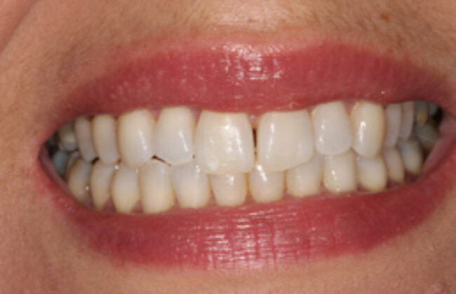 After (Teeth)