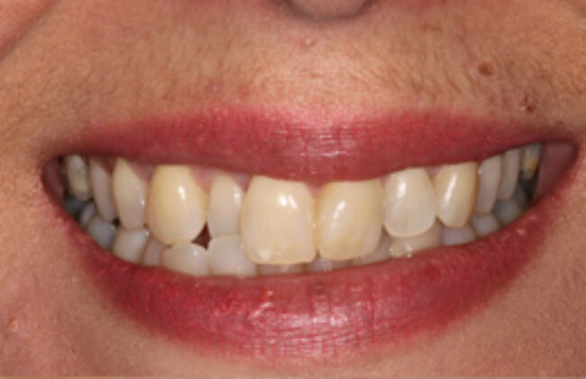Before (Teeth)