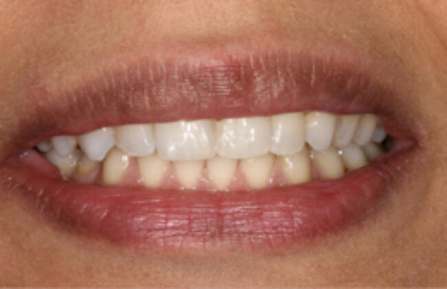 After (Teeth)