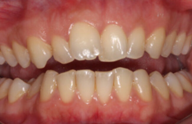 Before (Teeth)