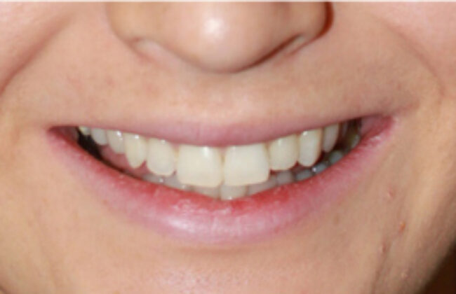 After (Teeth)