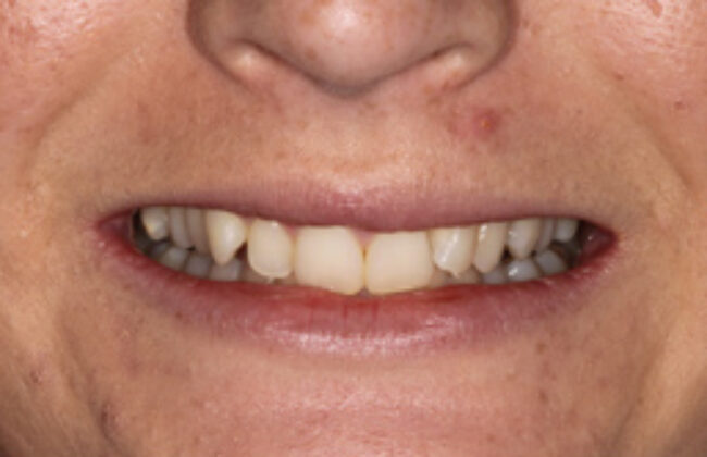 Before (Teeth)