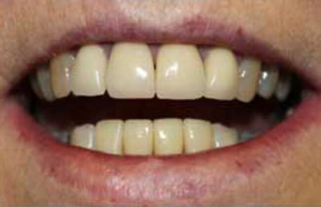 After (Teeth)