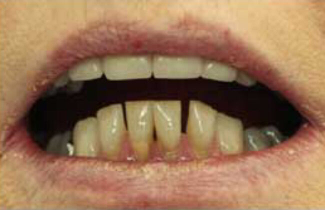 Before (Teeth)