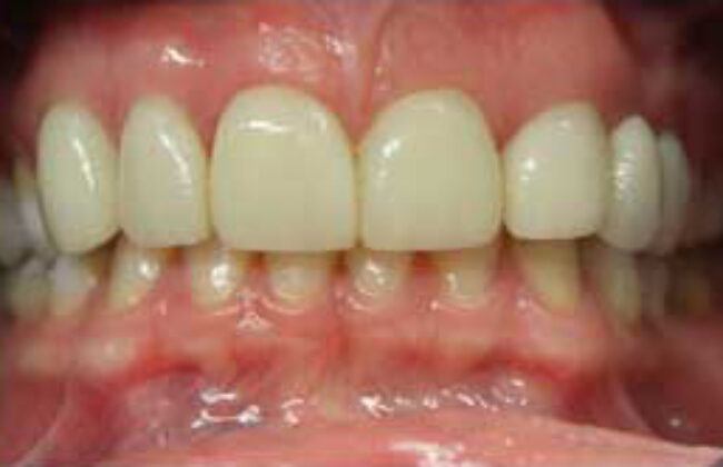 After (Teeth)