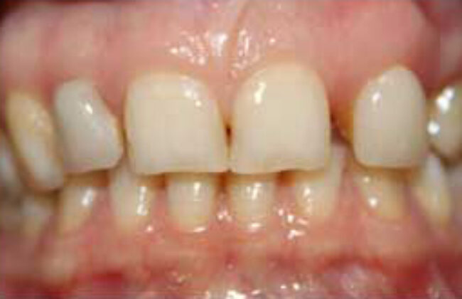 Before (Teeth)