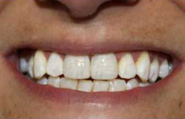 After (Teeth)