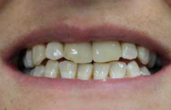Before (Teeth)