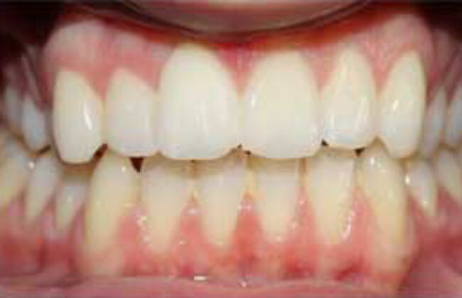 After (Teeth)