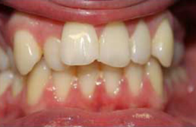 Before (Teeth)