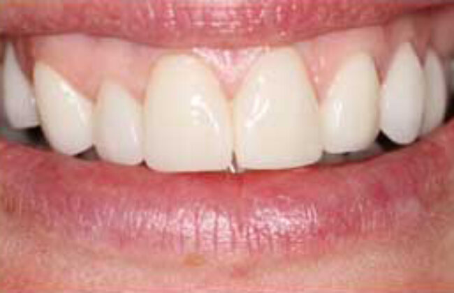 After (Teeth)