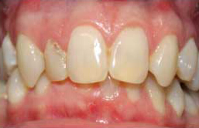 Before (Teeth)