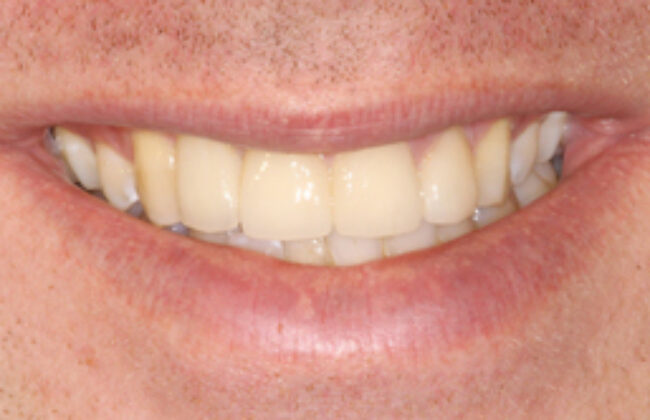 After (Teeth)