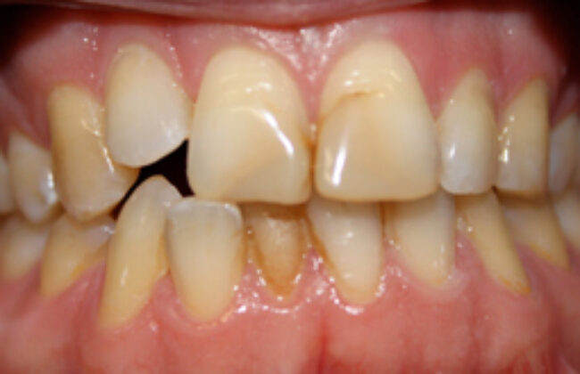 Before (Teeth)