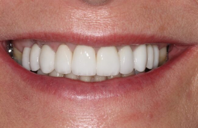 After (Teeth)