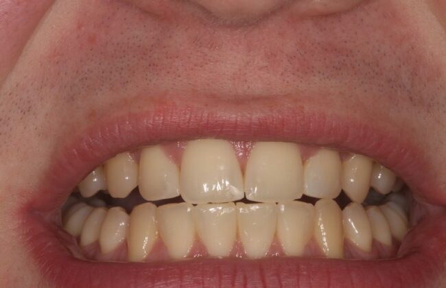 After (Teeth)