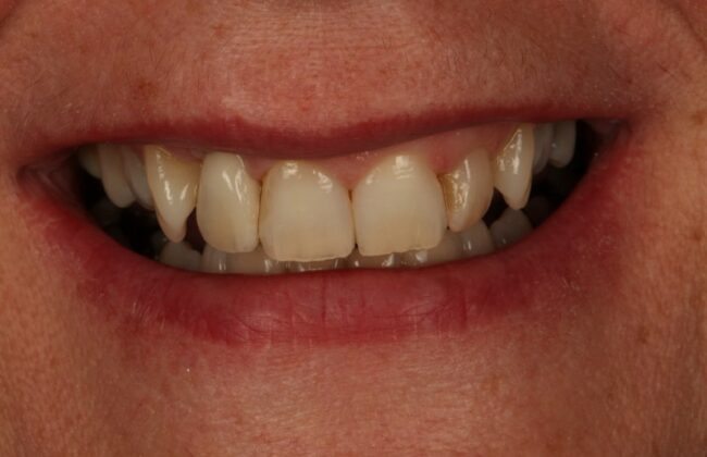 After (Teeth)