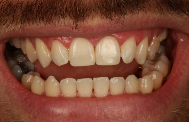 After (Teeth)
