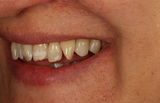 After (Teeth)