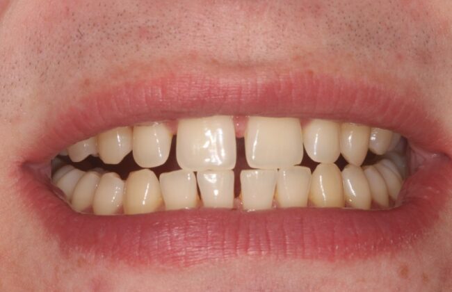 Before (Teeth)