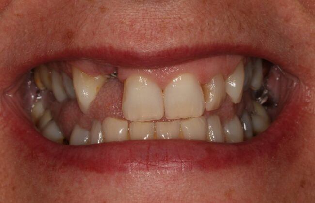 Before (Teeth)