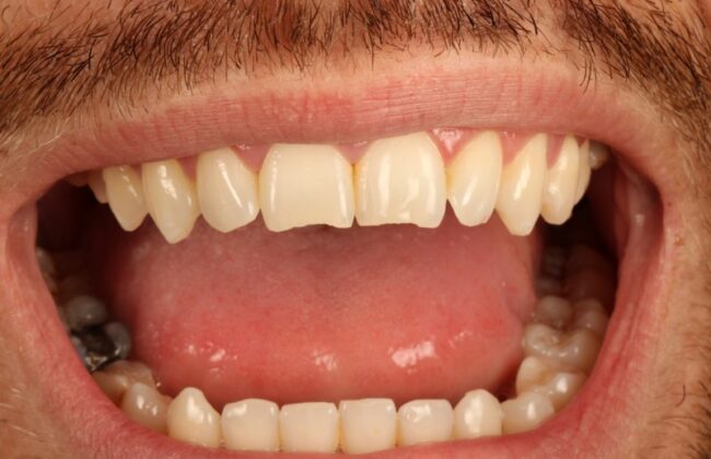 Before (Teeth)