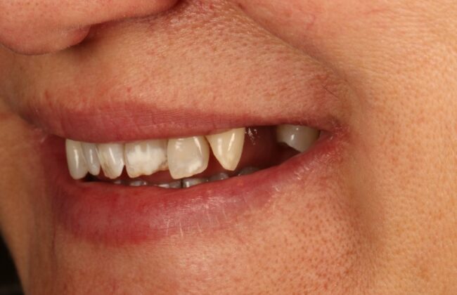 Before (Teeth)