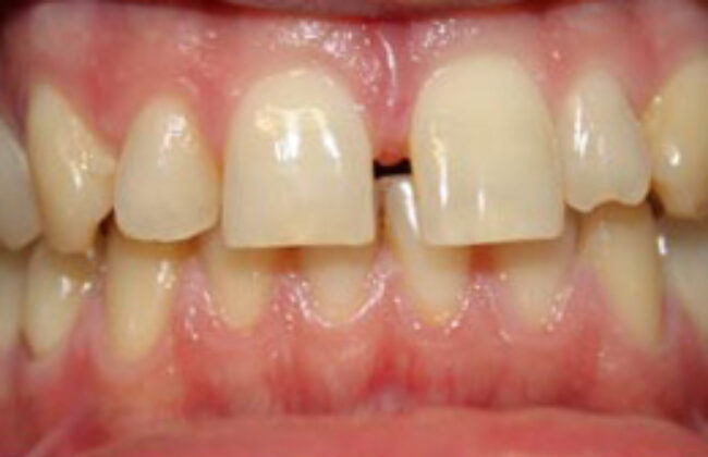 Before (Teeth)