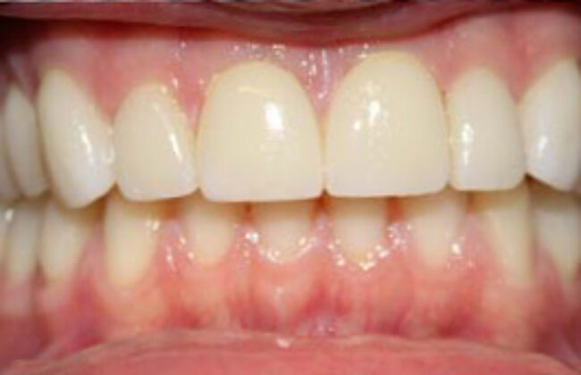 After (Teeth)