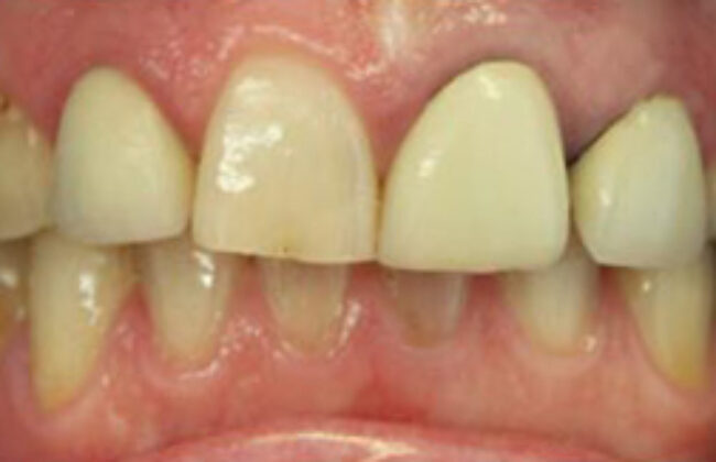 Before (Teeth)