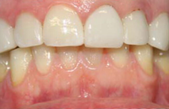 After (Teeth)