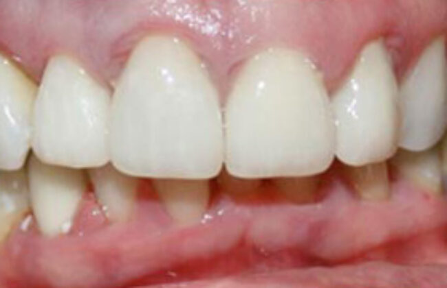 After (Teeth)