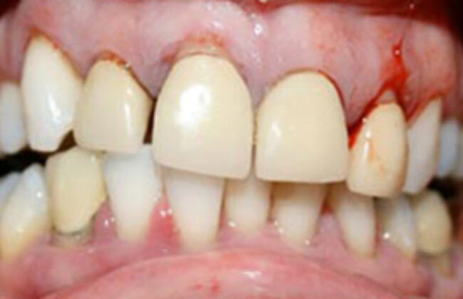 Before (Teeth)