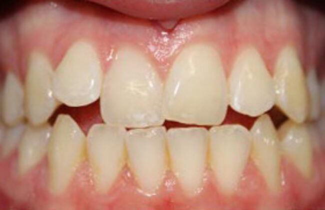 Before (Teeth)