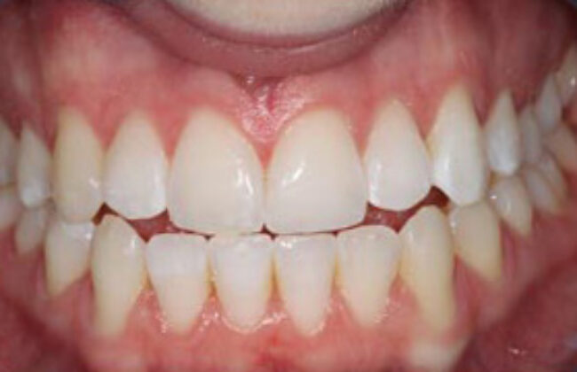 After (Teeth)
