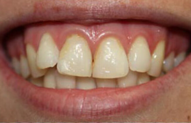 Before (Teeth)