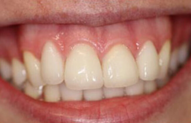 After (Teeth)