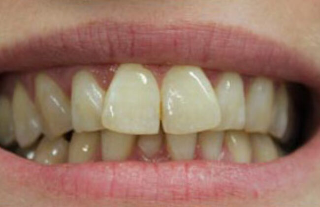 Before (Teeth)