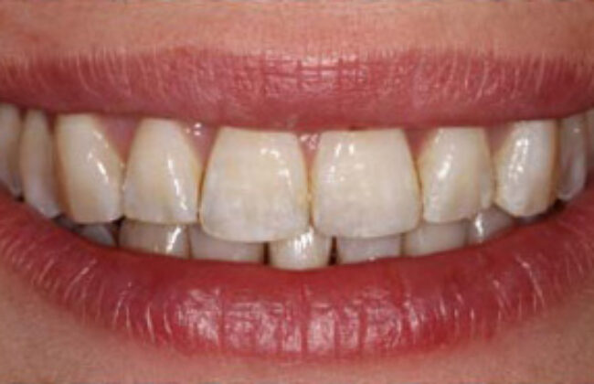 After (Teeth)